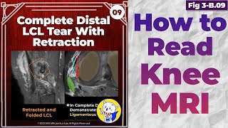 Fig 3B09 Complete Distal LCL Tear with Retraction [upl. by Ayoted]