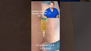 Bakers Cyst drainage under ultrasound [upl. by Christopher984]