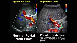 Liver Ultrasound Normal Vs Abnormal Image Appearances Comparison  Liver Pathologies USG [upl. by Ase149]