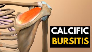 Calcific Bursitis Causes Signs and Symptoms Diagnosis and Treatment [upl. by Brie]