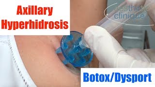 BotoxDysport for Axillary Hyperhidrosis  Dr Weiners Unique Method [upl. by Garrek283]