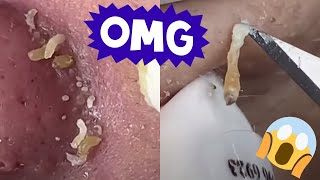 Ultimate Pimple Popping Satisfaction 💥 [upl. by Tertius]