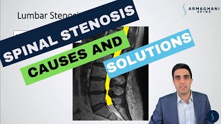 Lumbar Spinal Stenosis  What is the cause and how will I get better [upl. by Corie]