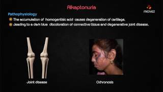 Ochronosis or Alkaptonuria  Usmle step 1 lecture [upl. by Venus]