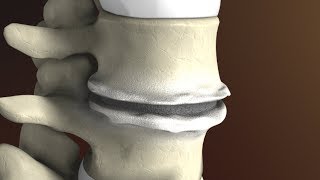 Degenerative Disc Disease Spondylosis explained by Spine Surgeon Dr Jessica Shellock Plano TX [upl. by Tess]