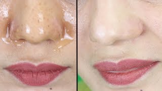 Easiest Way To Remove Blackheads amp Whiteheads In Some Minutes  Remove Blackheads From Your Nose [upl. by Aibar279]