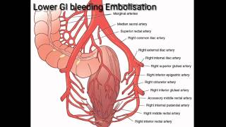 Lower GI bleeding Bleeding PREndovascular treatment by EmbolisationEmborrhoids for bleeding piles [upl. by Nnahgiel450]