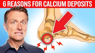 6 Reasons for Calcium Deposits Spurs Osteophytes Stones and Tartar [upl. by Barrus]