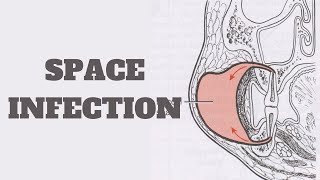 Dental Space Infection  Cellulitis  Ludwig Angina  Canine  Buccal Space [upl. by Dorcea]