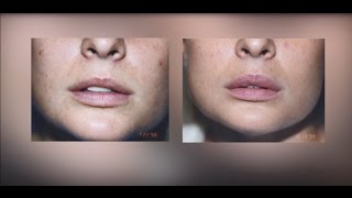 Lip Augmentation Silicone Fillers Injectables [upl. by Nahta]