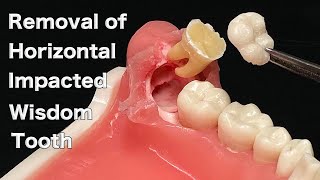 removal of horizontal impacted wisdom teeth [upl. by Ferrell493]