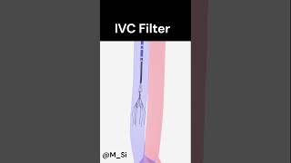 Inferior Vena Cava IVC Filter [upl. by Crissy744]