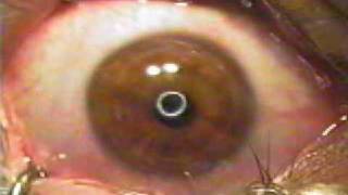 Nystagmus Eyes Under A Lasik Machine [upl. by Kathrine132]