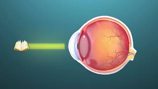 Presbyopia ophthalmology  Animation [upl. by Anay150]