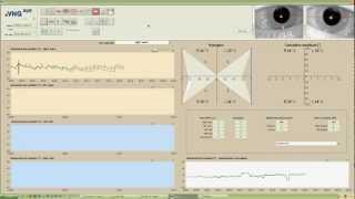 eVNG Caloric Test Demo [upl. by Lemhar]