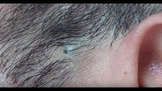 ingrown hair removal [upl. by Oirromed248]