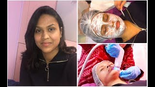 RF Micro Needling For Acne Scars Uneven Skintone amp Dark Circles  My Experience [upl. by Cherish685]