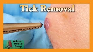 Dead Tick Removal  Auburn Medical Group [upl. by Anahsirk46]