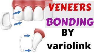 Veneers Bonding Cementation luting Protocol variolink ivoclar n instructions and guide with steps [upl. by Uela]