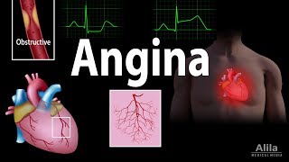 Angina Stable Unstable Microvascular and Prinzmetal Animation [upl. by Evers]