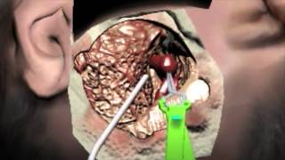 Haptic Virtual Reality Aneurysm Clipping [upl. by Lengel]