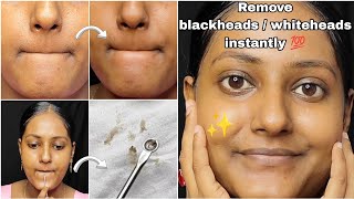 How to remove blackheads and Whiteheads at home  Remove blackheads and Whiteheads instantly 💯 [upl. by Eniamirt]