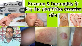 SBL Graphites Ointment Eczema Dermatitis की बेस्ट होम्योपैथिक मेडिसिन [upl. by Eikcaj]