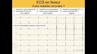 Infarctus ou variante rare africaine de repolarisation  Quiz ECG Dr Taboulet [upl. by Kristel]