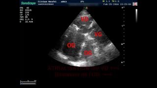 Anomalie dEbstein anesthésie réanimation et échocardiographie [upl. by Gerdy]