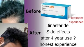 Finasteride side effects after 4 years use and results EXPERIENCE Hair treatment part 5 [upl. by Jaehne]