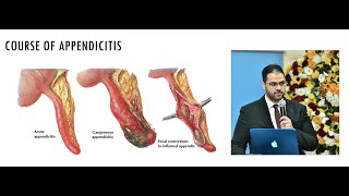 Acute appendicitis lecture Diagnosis and management arabic [upl. by Herschel]