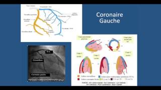 Coronarographie et Angioplastie coronaire [upl. by Terrilyn]