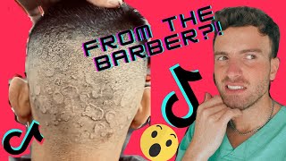 Getting A Ringworm Infection From Your Barber [upl. by Biles]