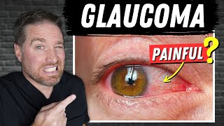 Treatment of AngleClosure Glaucoma  Dr Alan Mendelsohn [upl. by Norab]