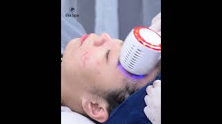 Acne Treatment for Inflamed Stomach [upl. by Rudwik152]