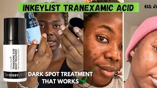 A Product I Love ft Inkeylist Tranexamic Acid Night Treatment Review [upl. by Puttergill]