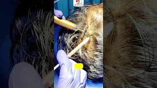 HAIR PRP Treatment for Hair Regrowth Aceasis Aesthetic Solution Live Patient Treatment 9674257567 [upl. by Quintilla]