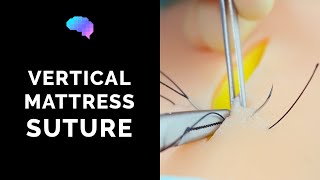 Vertical Mattress Suture  OSCE Guide  UKMLA  CPSA [upl. by Ande]