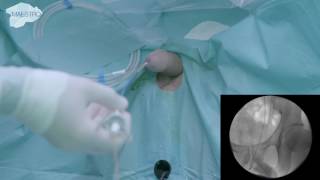 Access Sheath placement under fluoroscopy [upl. by Ethe161]