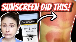 SUNSCREEN allergic reactions and rashes Dr Dray [upl. by Godber917]