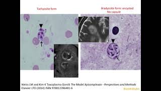 32 Toxoplasmosis opportunistic infection HIVAIDS target lesion with tachyzoites and bradyzoites [upl. by Nertie]