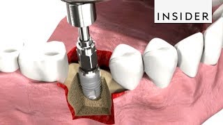 How Dentists Insert Dental Implants [upl. by Euqininod]