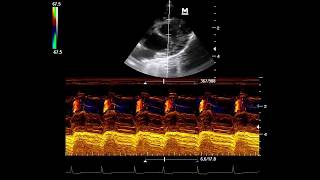 Ductus Arterioso Persistente [upl. by Chadwick613]