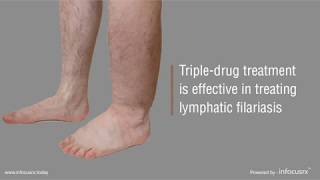 Tripledrug treatment is effective in treating lymphatic filariasis [upl. by Astrea]