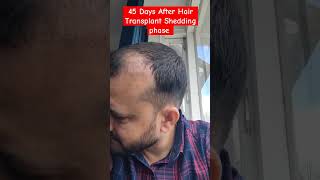 Day 45 After Hair Transplant  Shedding Phase besthairtransplant [upl. by Kokoruda]