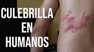 Culebrilla en humanos  Explicación médica [upl. by Hansen]