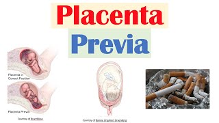 Placenta Previa Low Lying Placenta  Risk Factors Symptoms amp Complications Diagnosis Treatment [upl. by Vashtee609]