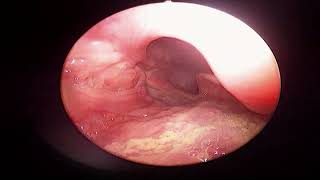 Fiberoptic Laryngoscopy [upl. by Medarda]