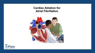 Cardiac Ablation for Atrial Fibrillation [upl. by Pasahow]