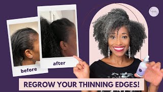 The Ultimate Guide to Regrowing Thinning Hair Edges [upl. by Nojed]